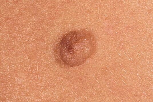 Simple papilloma