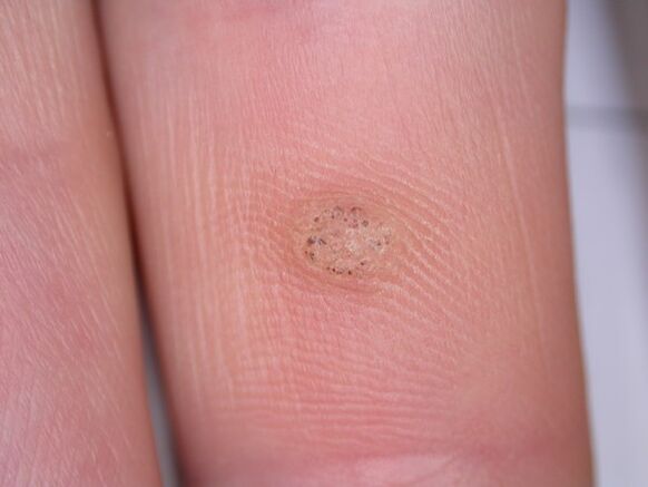 Can warts cause cancer