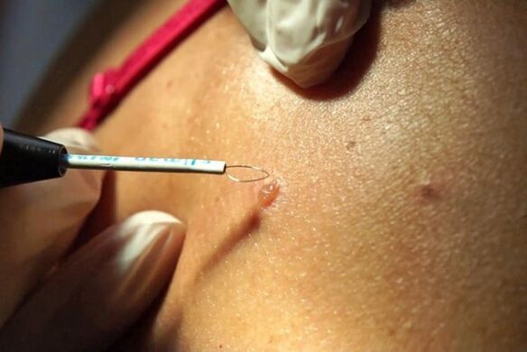 Removal of warts on the body