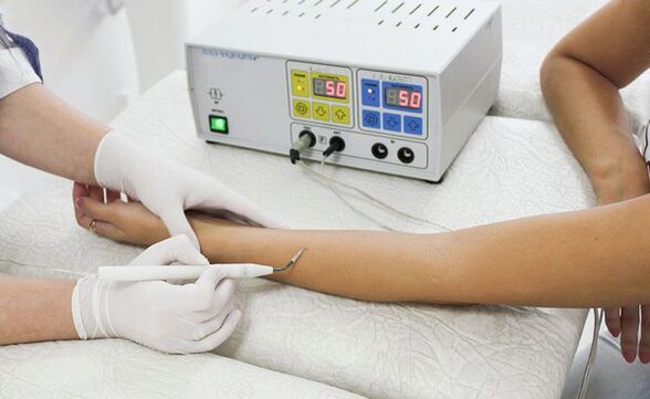 Removal of warts using radio waves