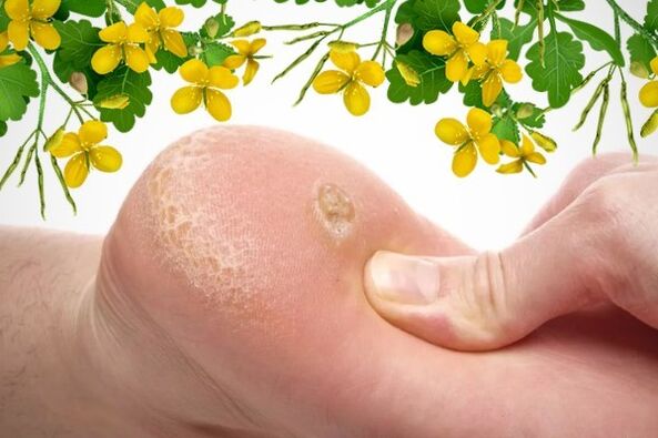 Ways to treat warts