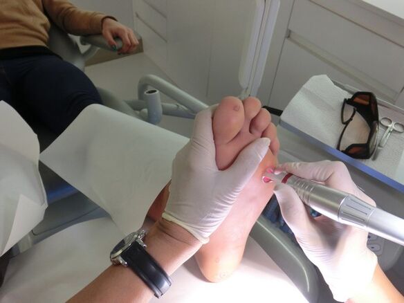 When to remove warts