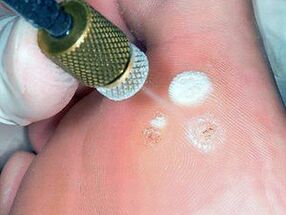 Cryodestruction as a method for plantar wart removal