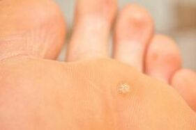 Why do plantar warts occur
